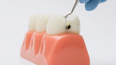Sâu răng nhẹ đánh răng có hết không? Khi nào cần trám răng?