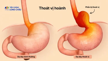 Thoát vị hoành là gì? Nguyên nhân, phương pháp chẩn đoán và điều trị