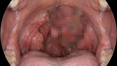 Thời gian ủ bệnh ung thư vòm họng là bao lâu? Hiểu đúng để phát hiện sớm