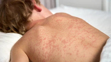 Tìm hiểu bệnh ban đào: Cách phòng ngừa và điều trị hiệu quả