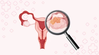 U nang bì buồng trứng là gì? Triệu chứng, nguyên nhân, chẩn đoán và điều trị