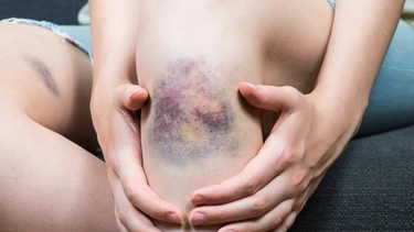 Vết bầm tím bao lâu thì hết? Nguyên nhân và cách làm mờ nhanh