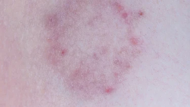 Vết tròn bị nổi đốm đỏ trên da không ngứa: Cảnh báo nguyên nhân ít người để ý