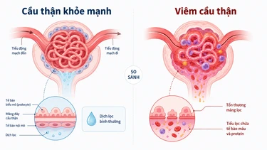 Viêm cầu thận mạn là gì? Dấu hiệu, nguyên nhân và cách kiểm soát bệnh