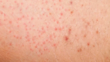 Viêm nang lông: Triệu chứng, nguyên nhân, chẩn đoán và điều trị