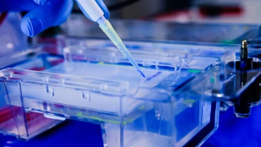 Xét nghiệm điện di protein là gì? Quy trình thực hiện và yếu tố ảnh hưởng kết quả