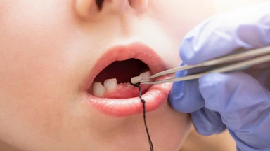 Nhổ răng sữa bao nhiêu tiền và những điều ba mẹ cần biết