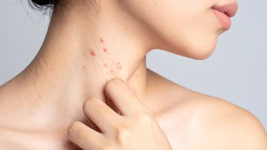 Mụn nhọt ở cổ có nguy hiểm không? Nguyên nhân và cách xử lý an toàn