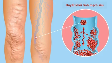 Huyết khối tĩnh mạch sâu: Nguyên nhân, triệu chứng và điều trị