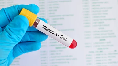 Xét nghiệm vitamin A: Khi nào cần thực hiện và cách đọc kết quả 