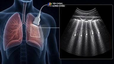 B-line phổi: Dấu hiệu trên siêu âm cảnh báo điều gì?