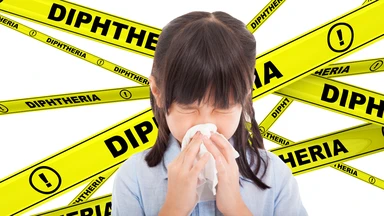 Bạch hầu ở mũi là gì? Triệu chứng, chẩn đoán, điều trị và phòng ngừa