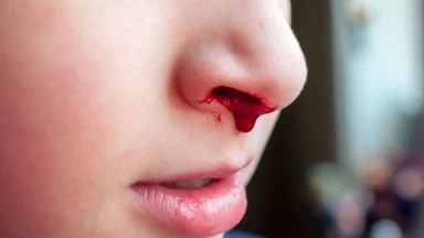 Bé hay chảy máu cam là thiếu chất gì? Nguyên nhân và cách cải thiện