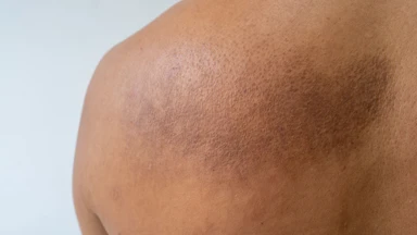 Bệnh Amyloidosis là gì? Những điều cần biết về bệnh Amyloidosis