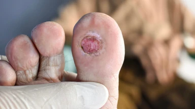 Bàn chân đái tháo đường là gì? Nguyên nhân và cách phòng ngừa hiệu quả