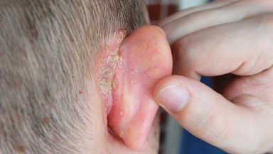 Chàm tai là gì? Nguyên nhân và cách phòng ngừa hiệu quả