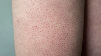 Dày sừng nang lông là gì? Nguyên nhân và cách phòng ngừa hiệu quả