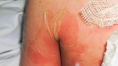 Hội chứng 4S là gì? Nguyên nhân và cách phòng ngừa hiệu quả