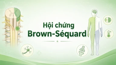 Hội chứng Brown-Séquard: Dấu hiệu, nguyên nhân, phương pháp chẩn đoán, điều trị và phòng ngừa