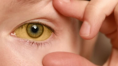 Hội chứng Gilbert: Dấu hiệu, nguyên nhân, phương pháp chẩn đoán, điều trị và phòng ngừa