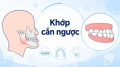 Khớp cắn ngược (răng móm) là gì? Nguyên nhân và cách phòng ngừa hiệu quả