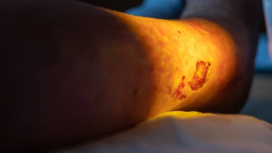 Loét Buluri là gì? Những điều cần biết về loét Buluri