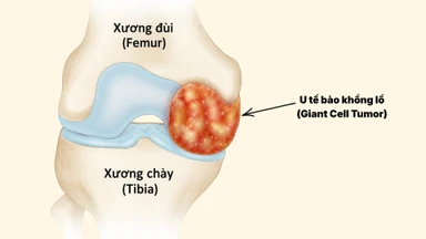 U tế bào khổng lồ: Dấu hiệu, nguyên nhân, phương pháp chẩn đoán, điều trị và phòng ngừa