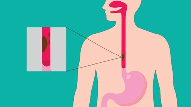 Ung thư thực quản là gì? Nguyên nhân, triệu chứng và cách điều trị