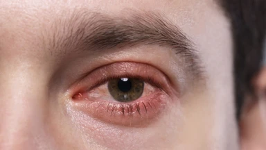 Viêm giác mạc là gì? Nguyên nhân và cách phòng ngừa hiệu quả