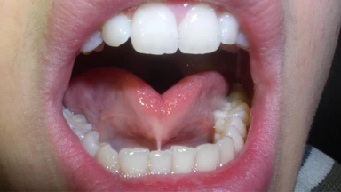 Bệnh cứng lưỡi là gì? Nguyên nhân, dấu hiệu và cách điều trị