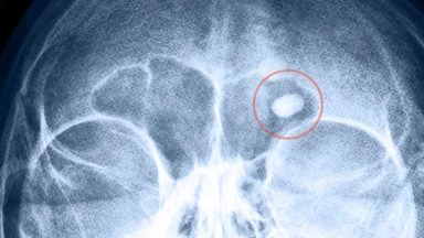 Bệnh osteoma là gì? Nguyên nhân, triệu chứng và cách điều trị
