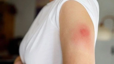 Bị áp xe vết tiêm: Nguyên nhân, dấu hiệu và cách điều trị