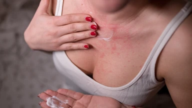 Bị dị ứng da nổi mẩn đỏ nguyên nhân là do đâu? Cách xử trí hiệu quả