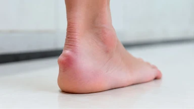 Biến dạng Haglund là gì? Nguyên nhân và cách điều trị hiệu quả 