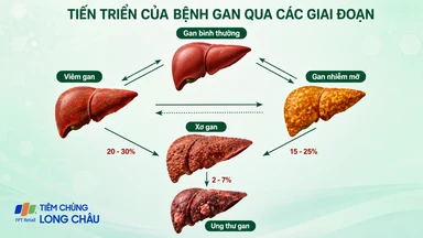 Các giai đoạn dẫn đến suy gan: Nhận biết sớm để bảo vệ gan