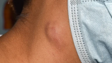 Các vị trí nổi hạch trên cơ thể và dấu hiệu phân biệt hạch lành tính, ác tính