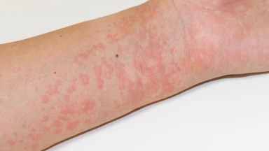 Cách chữa dị ứng thời tiết nổi mề đay an toàn và hiệu quả