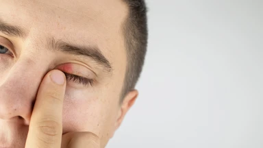 Cách chữa sưng mí mắt trên nhanh nhất: Hướng dẫn giảm sưng an toàn