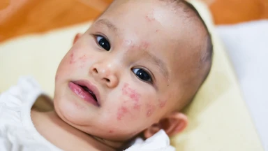 Cách làm sạch da cho trẻ bị viêm da cơ địa mà phụ huynh nên biết
