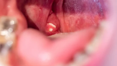 Cách lấy hạt trắng trong họng an toàn và đúng cách