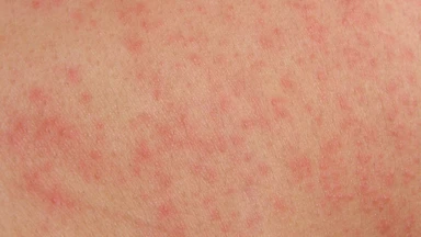 Cách phân biệt phát ban sốt xuất huyết và tử ban mô cầu