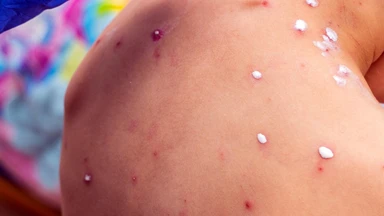 Cách xét nghiệm thủy đậu và quy trình chẩn đoán