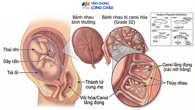 Canxi hoá bánh nhau là gì? Nguyên nhân, mức độ và cách theo dõi trong thai kỳ