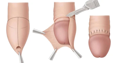 Cắt bao quy đầu có tác dụng gì? Lợi ích và những điều cần biết