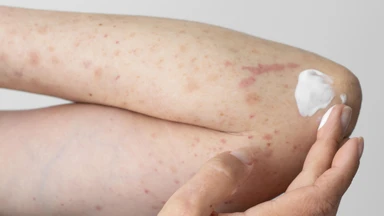 Chăm sóc da sau khi bị thủy đậu và những sai lầm cần tránh