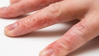 Chàm và viêm da cơ địa có giống nhau không? Cách phân biệt