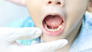 Chi phí cắt thắng lưỡi bao nhiêu và lưu ý cần biết