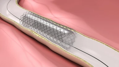 Chi phí đặt stent mạch cảnh hết bao nhiêu? Những điều cần biết 
