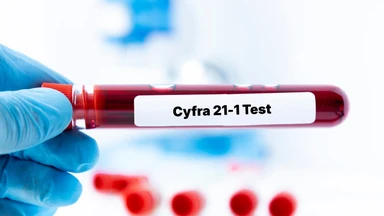 Chỉ số xét nghiêm Cyfra 21-1​ là gì? Các yếu tố làm tăng chỉ số Cyfra 21-1