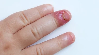 Chín mé: Nguyên nhân, dấu hiệu và cách điều trị hiệu quả